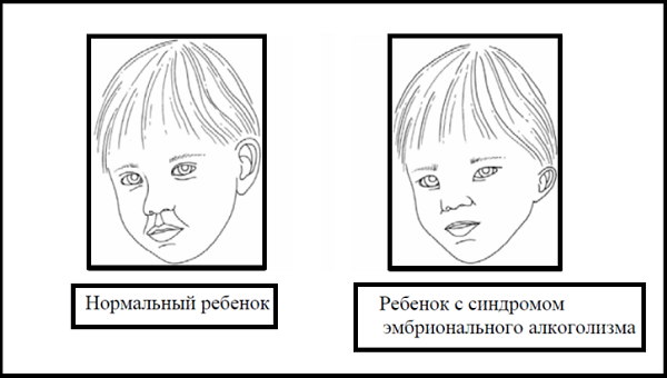 Фетальный алкогольный синдром признаки фото у детей